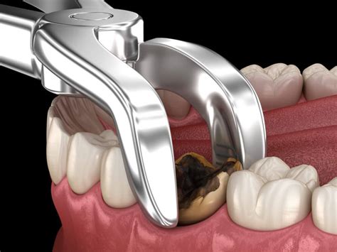 Tooth extractions rincon Dry socket (alveolar osteitis) is a painful dental condition that sometimes happens after you have a permanent adult tooth extracted